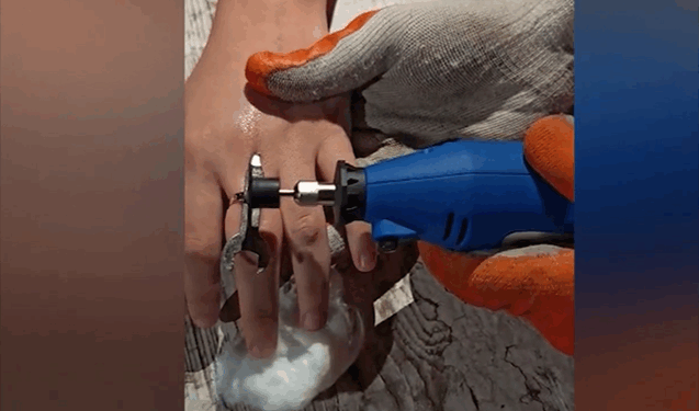 Qızın barmağında qalan üzüyü belə çıxardılar - VİDEO