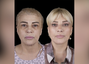 Mətanət İsgəndərli əməliyyatla belə dəyişdi – FOTOLAR