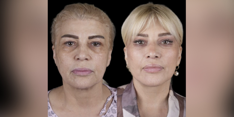 Mətanət İsgəndərli əməliyyatla belə dəyişdi - FOTOLAR